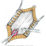 herniaA GL Illustration