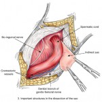 herniaB GL Illustration