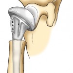 shoulderfix1 GL Illustration