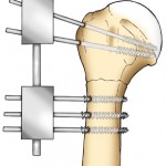 shoulderfix2 GL Illustration