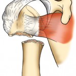 shoulderfracture GL Illustration