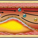 stent1a GL Illustration